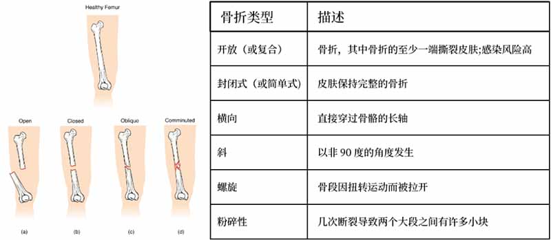 骨折分類